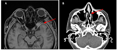 Multiple Cranial Neuropathies and Pachymeningitis as Initial Manifestations in Two Patients with Granulomatosis with Polyangiitis